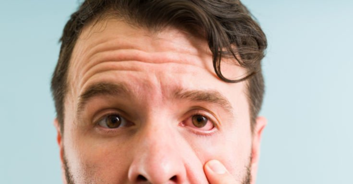 Why Do Eyes Turn Red? Causes, Symptoms & Prevention